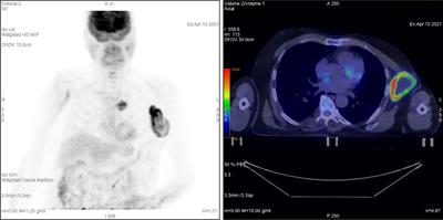 A Novel Radiotherapeutic Approach to Treat Bulky Metastases Even From Cutaneous Squamous Cell Carcinoma: Its Rationale and a Look at the Reliability of the Linear-Quadratic Model to Explain Its Radiobiological Effects